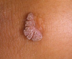 papillomas krem papillomas krem